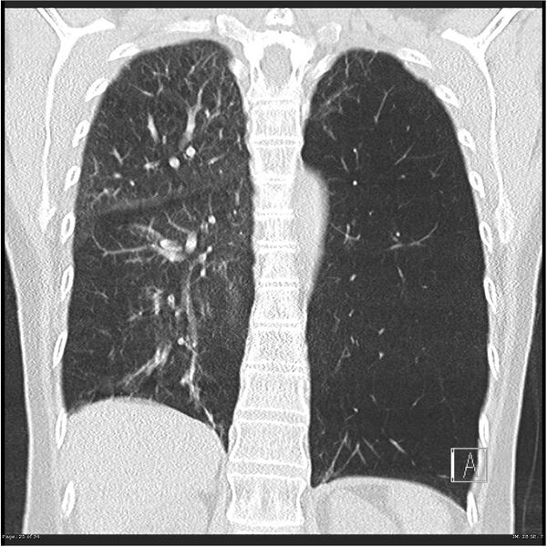 File:Alpha-1-antitrypsin deficiency (Radiopaedia 26537-26678 Coronal lung window 25).jpg
