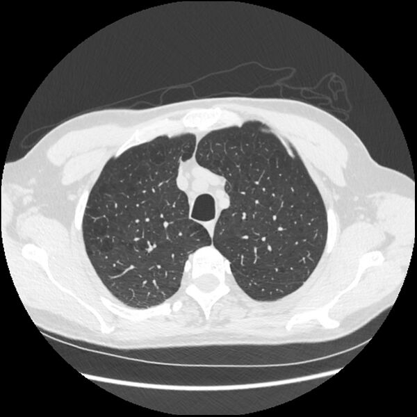 File:Alpha-1-antitrypsin deficiency (Radiopaedia 40993-43722 Axial lung window 41).jpg