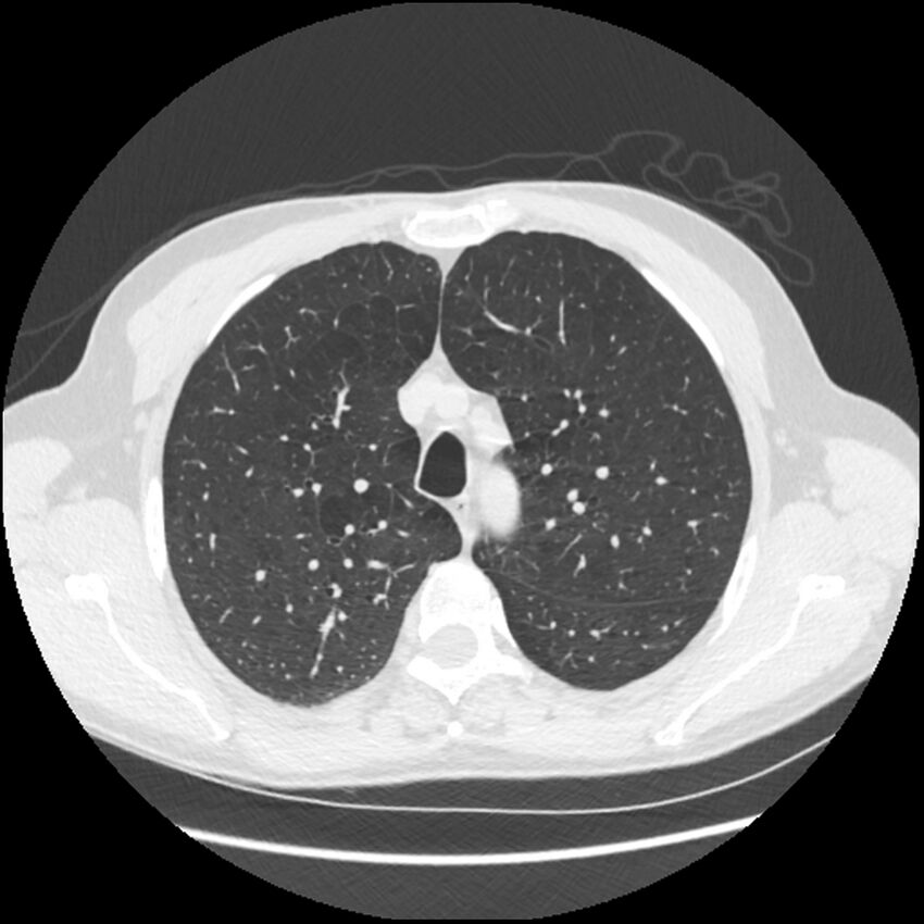 Alpha-1-antitrypsin deficiency (Radiopaedia 40993-43722 Axial lung window 57).jpg