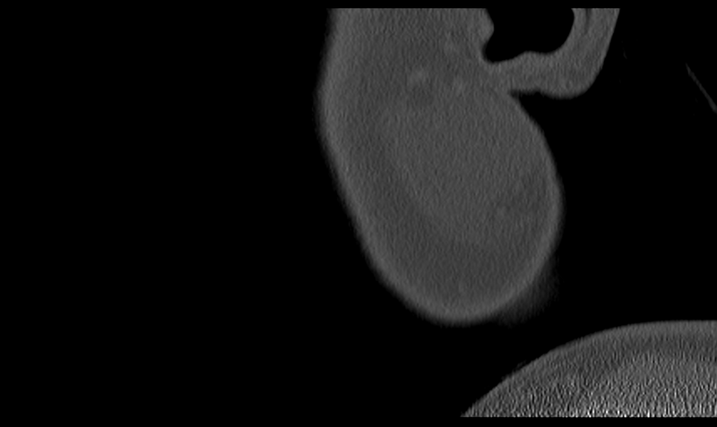 File:Ameloblastoma (Radiopaedia 33677-34806 Sagittal bone window 5).png