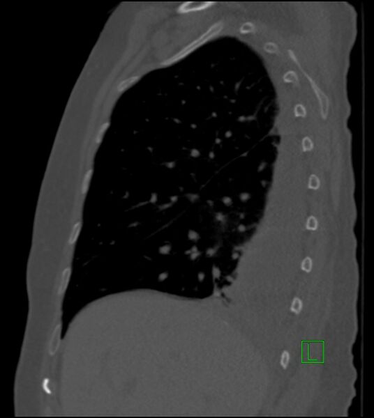 File:Amiodarone deposition in the liver (Radiopaedia 77587-89780 Sagittal bone window 70).jpg