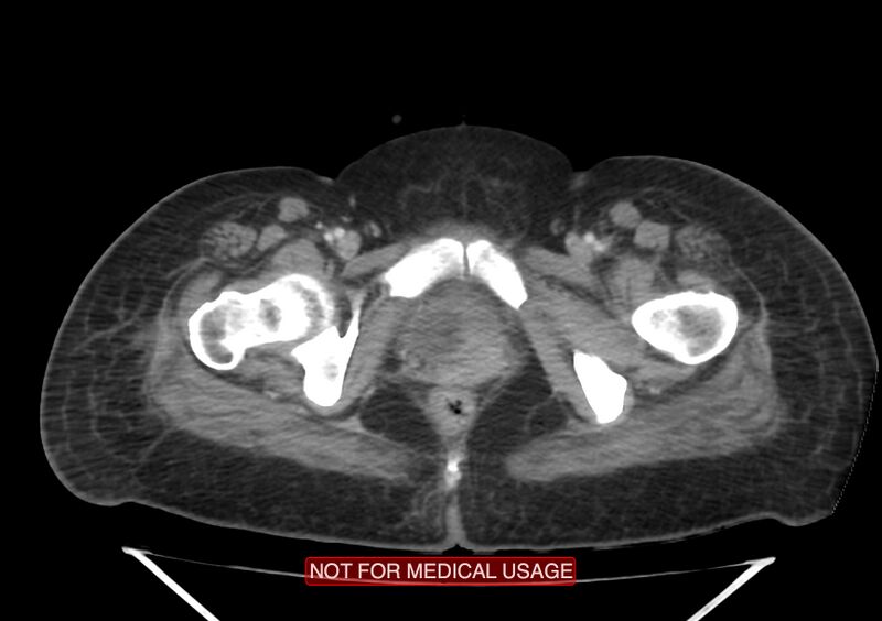 File:Amoebic enterocolitis with liver abscess (Radiopaedia 35100-36609 A 82).jpg