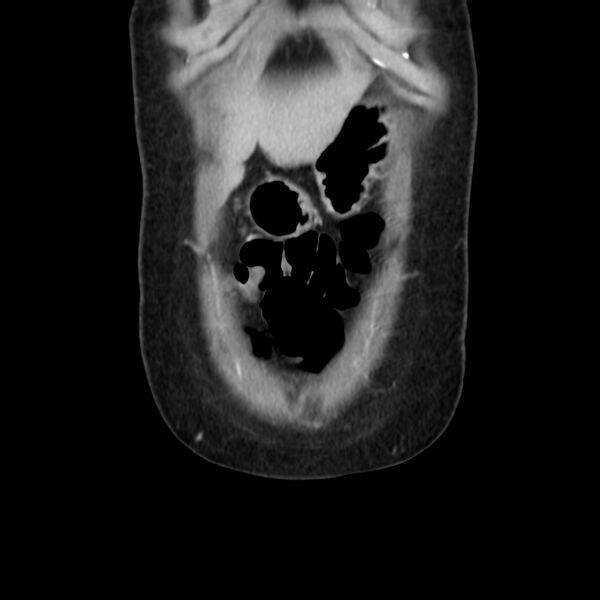 File:Ampullary tumor (Radiopaedia 22787-22816 E 9).jpg