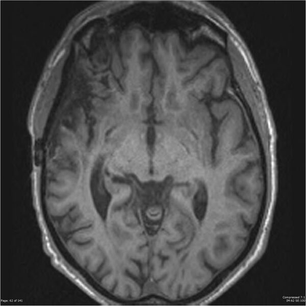 File:Anaplastic meningioma with recurrence (Radiopaedia 34452-35788 Axial T1 60).jpg