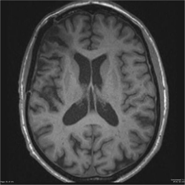 File:Anaplastic meningioma with recurrence (Radiopaedia 34452-35788 Axial T1 79).jpg