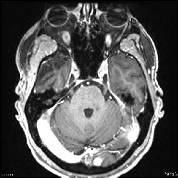 File:Anaplastic meningioma with recurrence (Radiopaedia 34452-35788 Axial T1 C+ 41).jpg