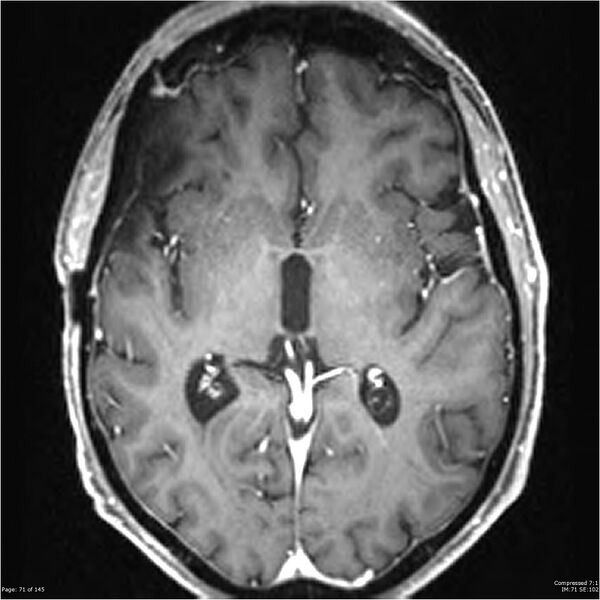 File:Anaplastic meningioma with recurrence (Radiopaedia 34452-35788 Axial T1 C+ 71).jpg