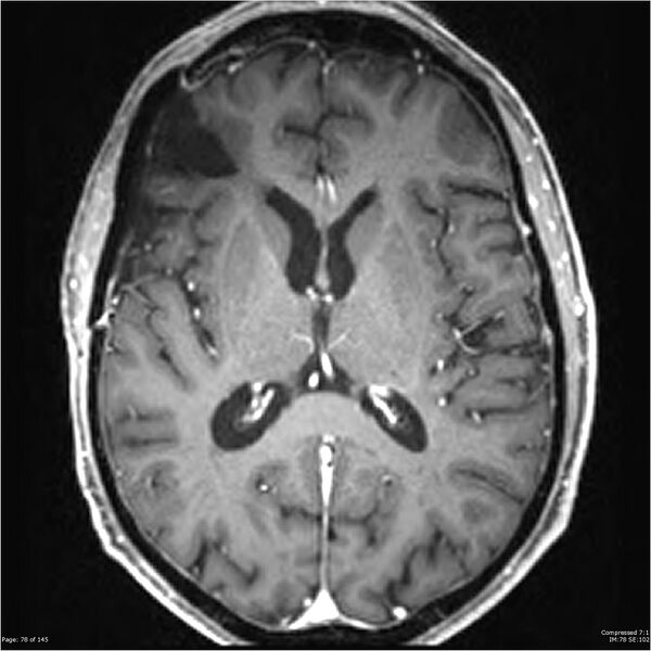 File:Anaplastic meningioma with recurrence (Radiopaedia 34452-35788 Axial T1 C+ 78).jpg