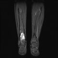 Aneurysmal bone cyst - tibia (Radiopaedia 22343-22367 Coronal STIR 11).jpg