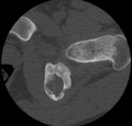 Aneurysmal bone cyst of ischium (Radiopaedia 25957-26094 B 24).png