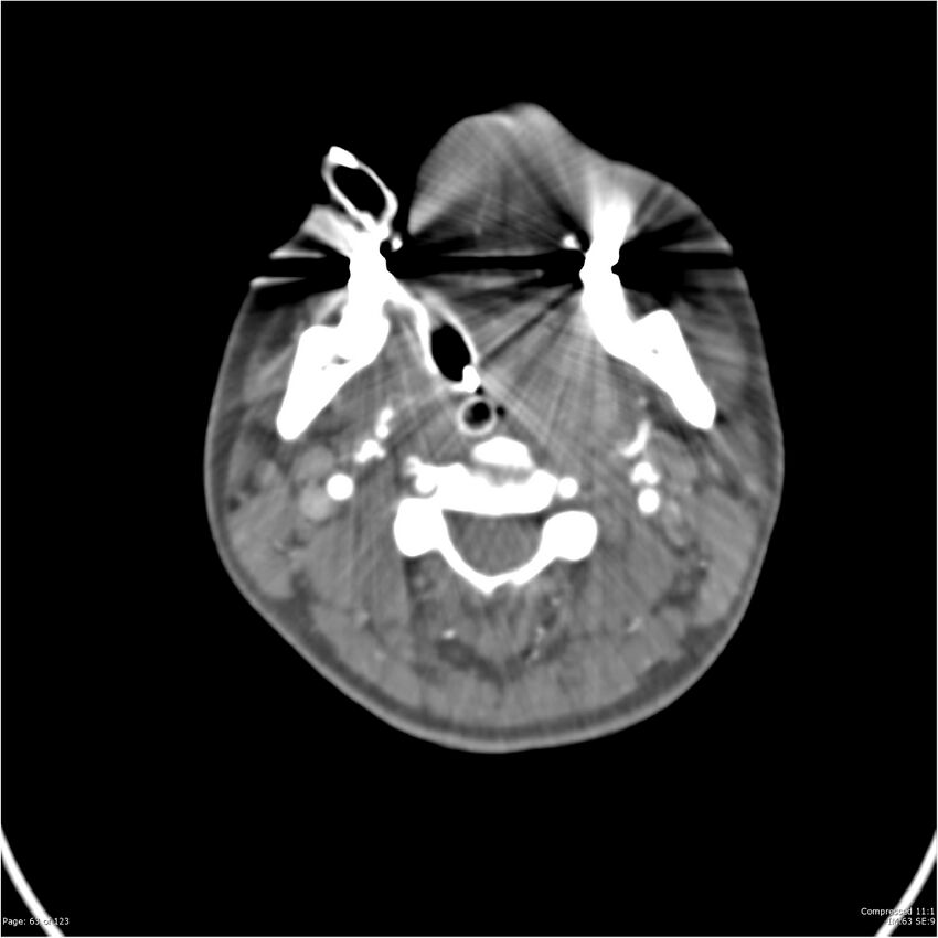 Aneurysmal subarachnoid hemorrhage and Moya Moya disease (Radiopaedia 34306-35593 Axial CT COW 63).jpg