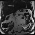Annular pancreas (Radiopaedia 38292-40320 Coronal T2 24).png