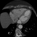 Anomalous origin of left circumflex artery from right coronary sinus (Radiopaedia 72563-83117 B 127).jpg