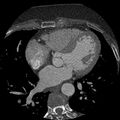 Anomalous origin of left circumflex artery from right coronary sinus (Radiopaedia 72563-83117 B 78).jpg