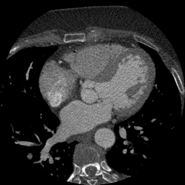 File:Anomalous origin of left circumflex artery from right coronary sinus (Radiopaedia 72563-83117 B 78).jpg