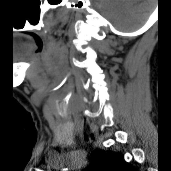 File:Anterior cervical postdiscectomy arthrodesis (Radiopaedia 32678-33646 C 9).jpg