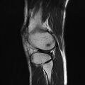 Anterior cruciate ligament full thickness tear (Radiopaedia 66268-75467 Sagittal T2 19).jpg