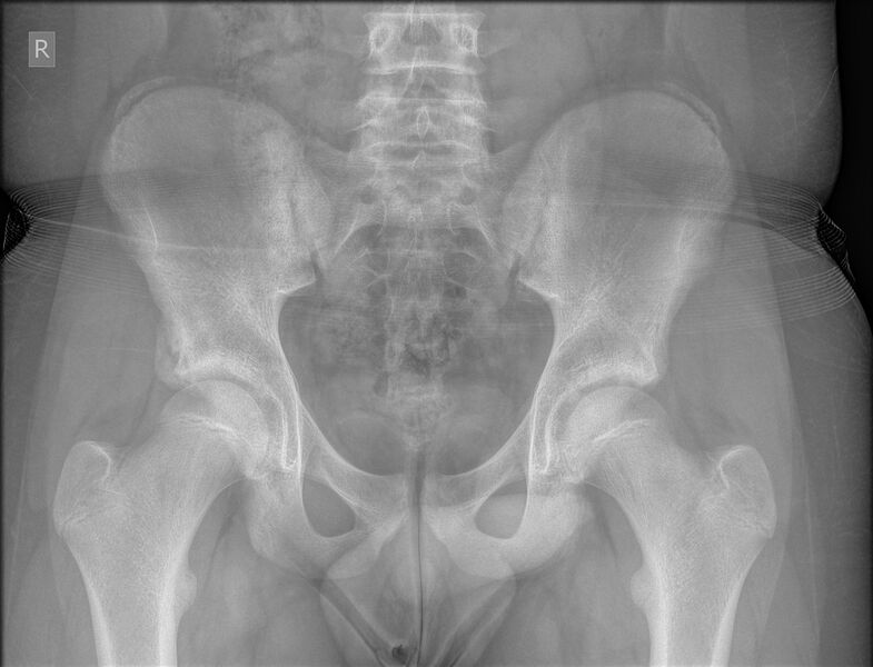 File:Anterior inferior iliac spine avulsion fracture (Radiopaedia 61170-69063 Frontal 1).jpg