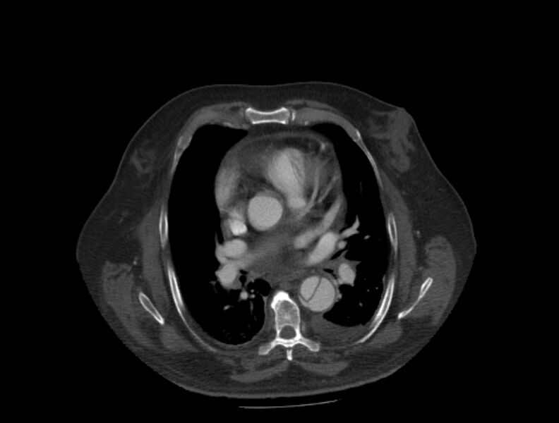 File:Aortic dissection (Radiopaedia 28802-29105 A 19).jpg