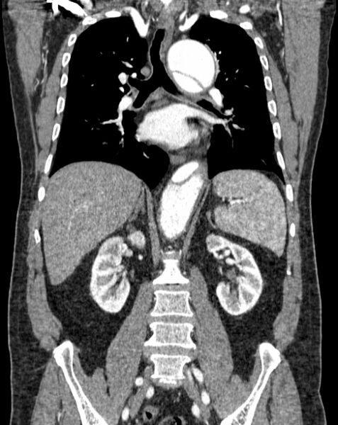 File:Aortic dissection (Radiopaedia 44411-48061 A 34).jpg