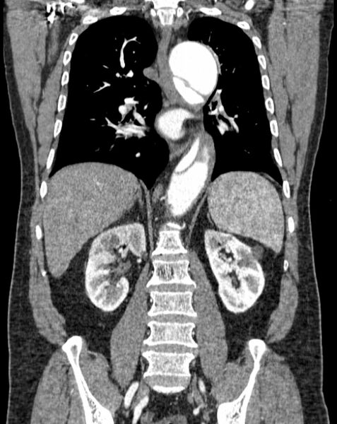 File:Aortic dissection (Radiopaedia 44411-48061 A 38).jpg