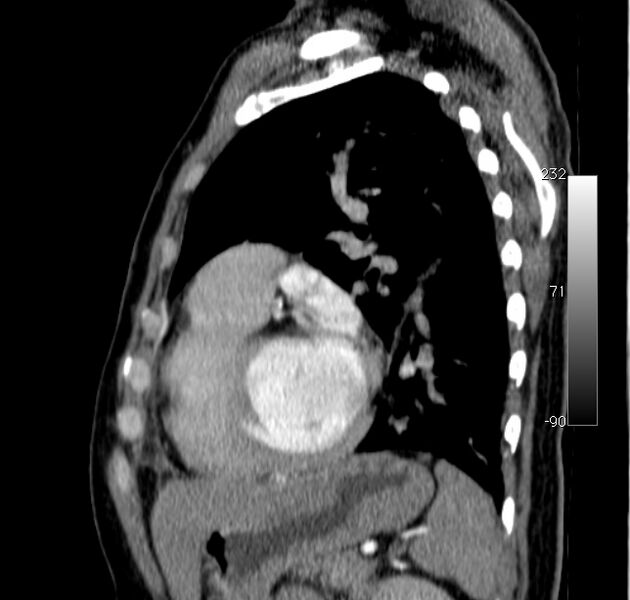 File:Aortic dissection - Stanford type A (Radiopaedia 29247-29659 C 13).jpg