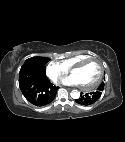 File:Aortic dissection with renal ischemia (Radiopaedia 76573-88338 A 47).jpg