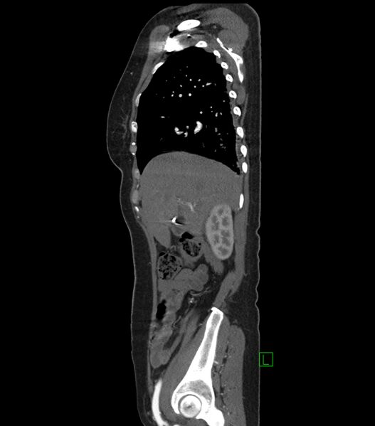 File:Aortic dissection with renal ischemia (Radiopaedia 76573-88338 D 1).jpg