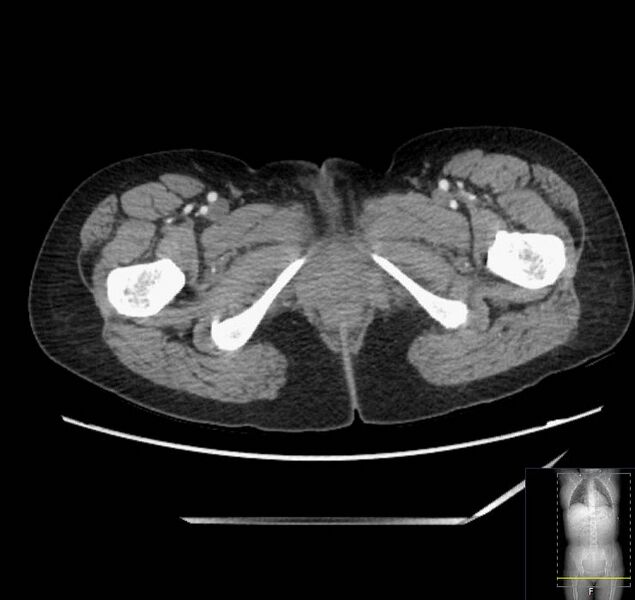 File:Appendicitis (CT angiogram) (Radiopaedia 154713-127660 Axial 106).jpg