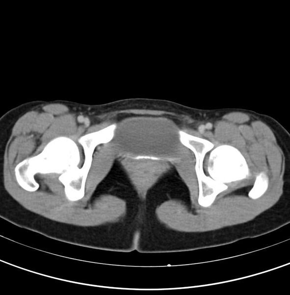 File:Appendicitis and incidental bicornuate uterus (Radiopaedia 22833-22853 Axial C+ delayed 40).jpg