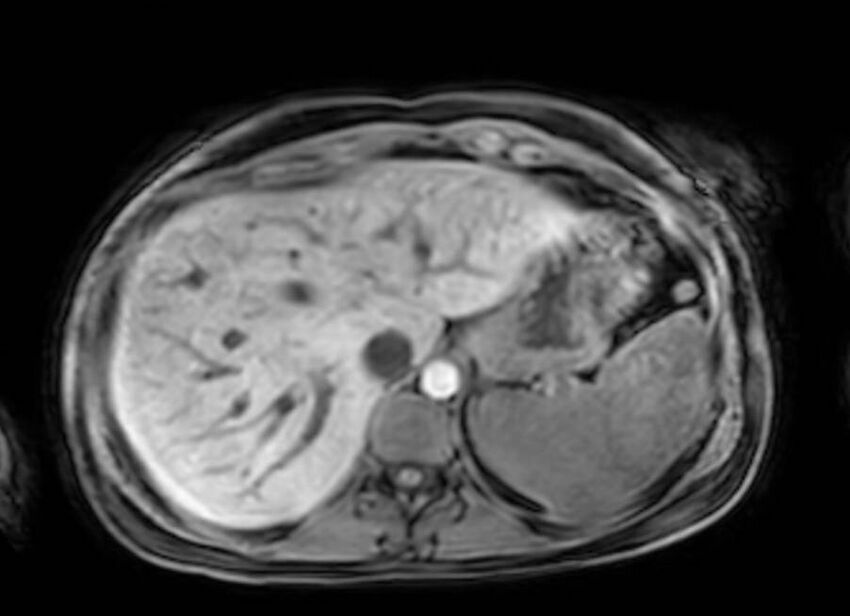 Appendicitis in gravida (MRI) (Radiopaedia 89433-106395 Axial DIXON 16).jpg