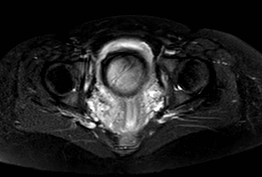 Appendicitis in gravida (MRI) (Radiopaedia 89433-106395 Axial T2 SPAIR 70).jpg