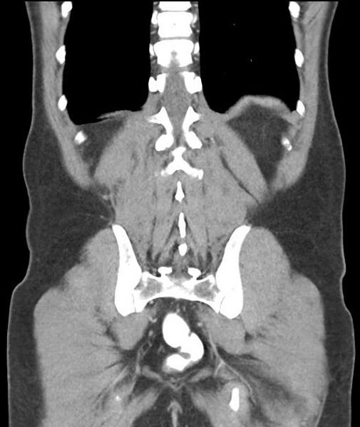 File:Appendicitis with cecal bar sign (Radiopaedia 31878-32830 A 49).jpg