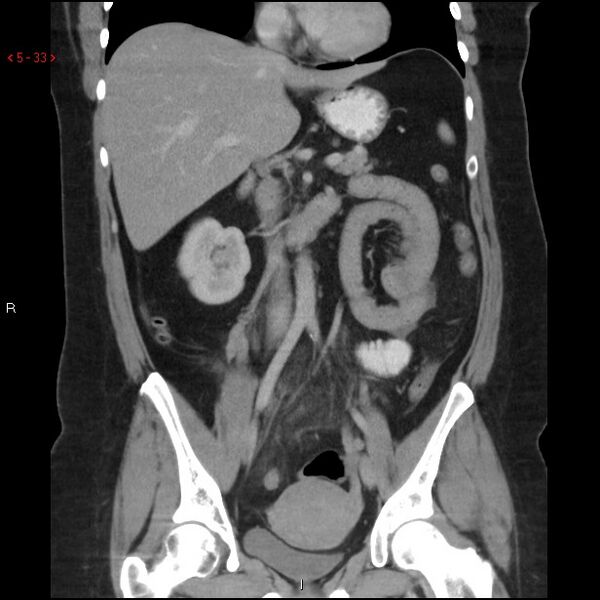 File:Appendicitis with microperforation- promontoric type (Radiopaedia 27268-27442 B 20).jpg