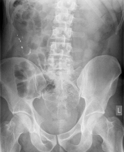 File:Appendix with retained barium (Radiopaedia 6435).jpg