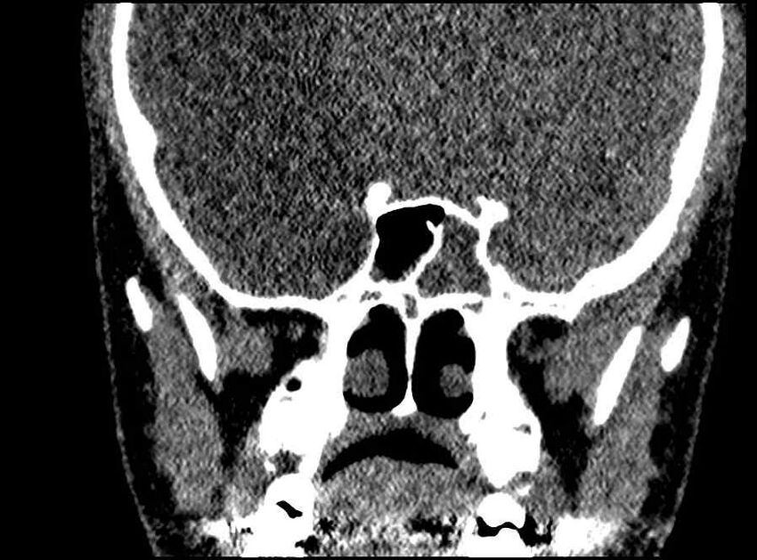 Arachnoid cyst- extremely large (Radiopaedia 68741-78450 Coronal bone window 26).jpg