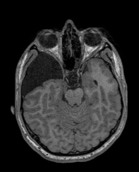 File:Arachnoid cyst- extremely large (Radiopaedia 68741-78451 Axial T1 28).jpg