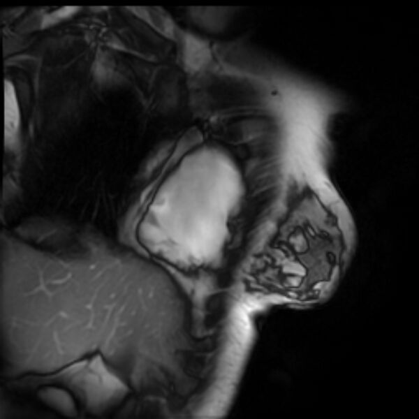 File:Arrhythmogenic right ventricular cardiomyopathy (Radiopaedia 87505-103850 2ch (RV) Cine SSFP 23).jpg