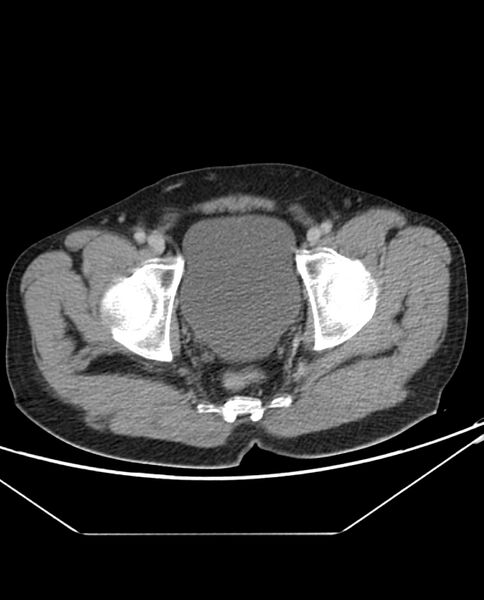 File:Arterial occlusive mesenteric ischemia (Radiopaedia 84641-100054 A 111).jpg