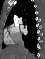 Arterial switch procedure (Radiopaedia 31607-32493 Sagittal 38).jpg