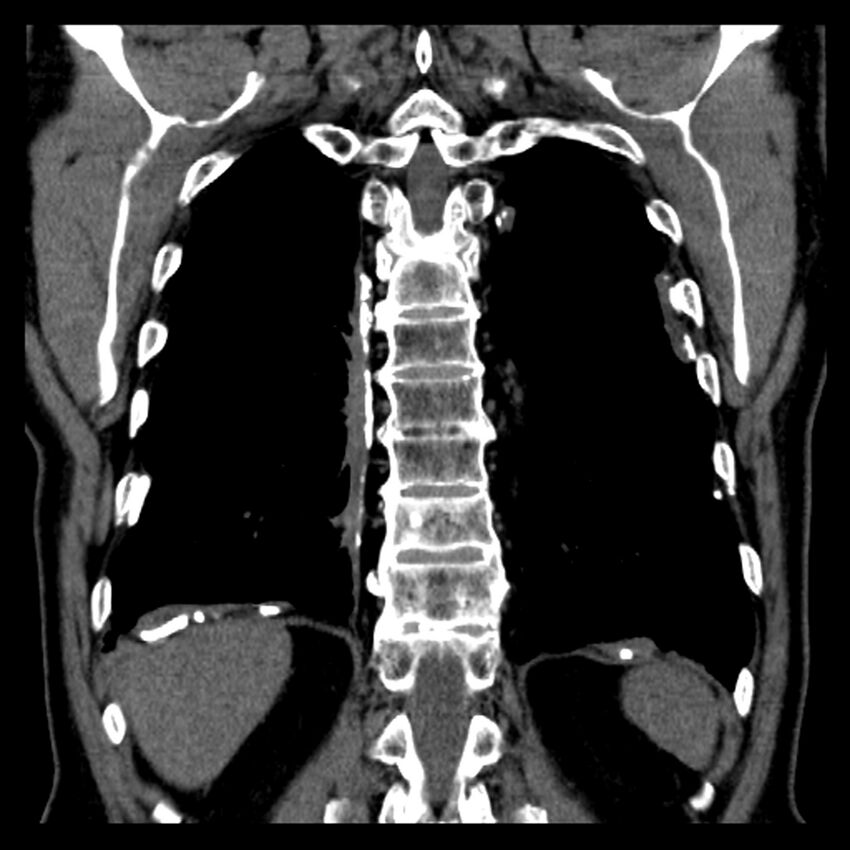 Asbestos-related pleural plaques (Radiopaedia 39069-41255 Coronal non-contrast 17).jpg