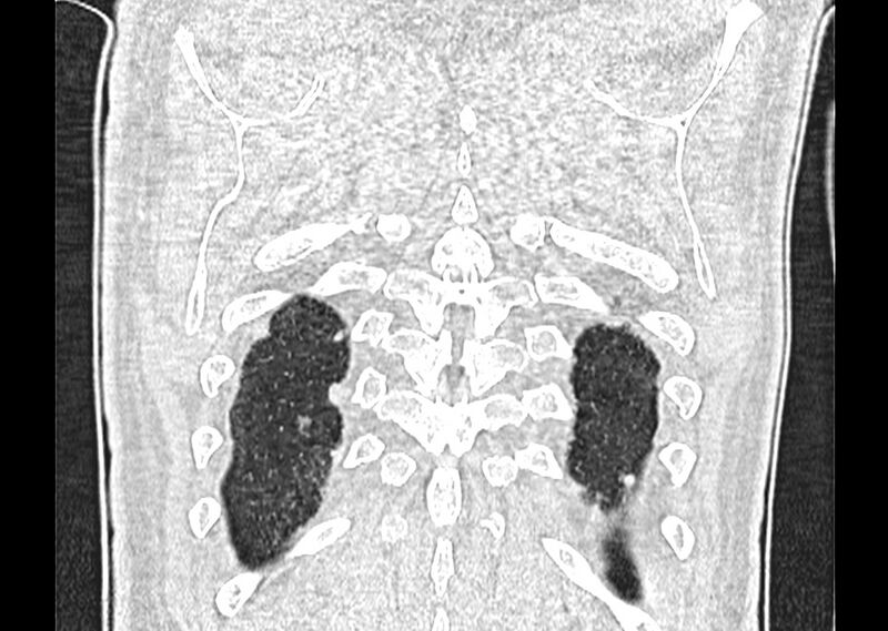 File:Asbestos pleural placques (Radiopaedia 57905-64872 Coronal lung window 271).jpg