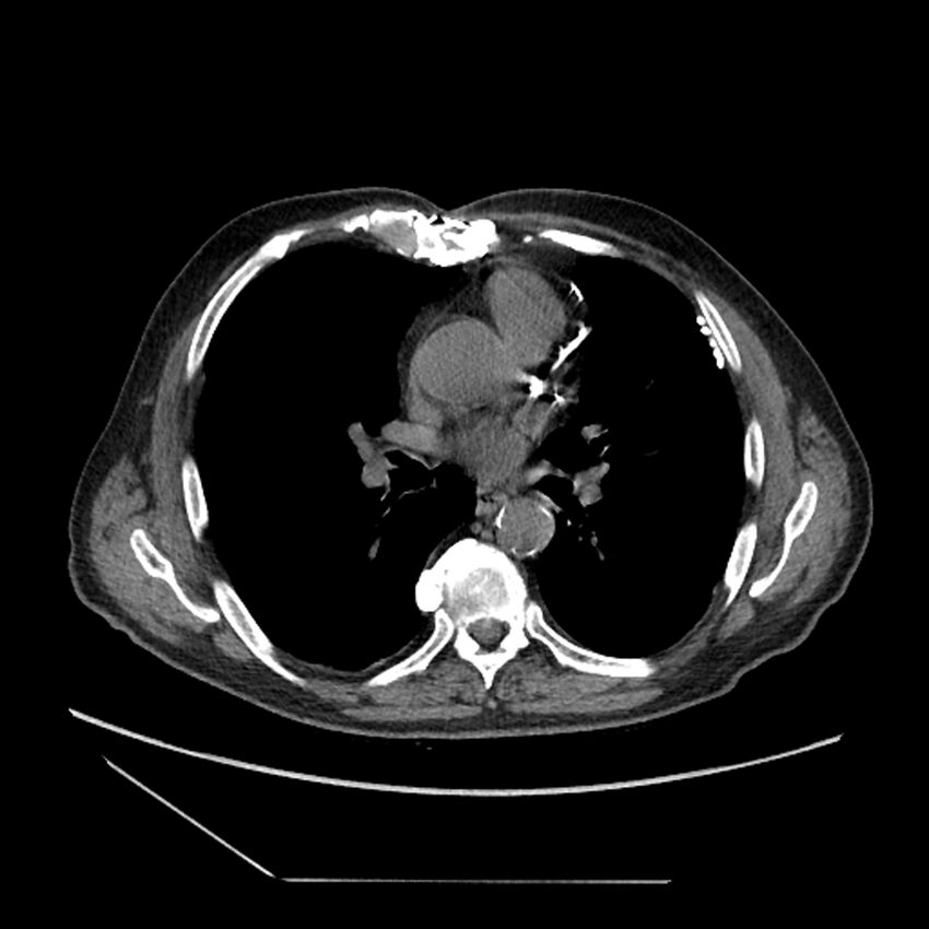 Asbestosis complicated by lung cancer (Radiopaedia 45834-50116 Axial non-contrast 34).jpg