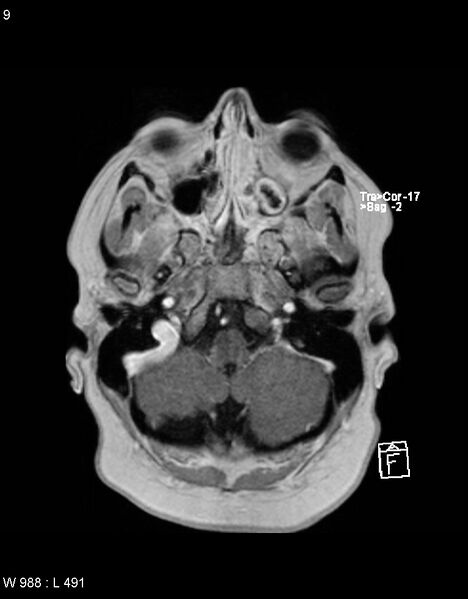 File:Astroblastoma (Radiopaedia 39792-42217 Axial T1 C+ 8).jpg