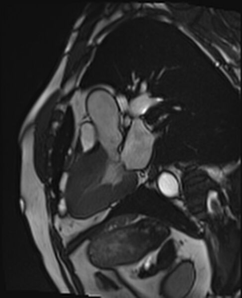 File:Asymmetric septal hypertrophic cardiomyopathy - systolic anterior motion of mitral leaflet (Radiopaedia 72795-83445 B 10).jpg