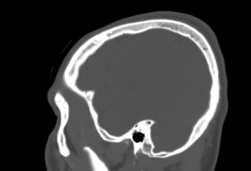 Asymptomatic occipital spur (Radiopaedia 87753-104201 Sagittal bone window 254).jpg