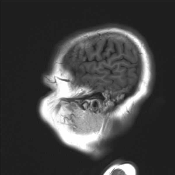 File:Atlanto-occipital assimilation with basilar invagination (Radiopaedia 70122-80157 Sagittal T1 22).jpg