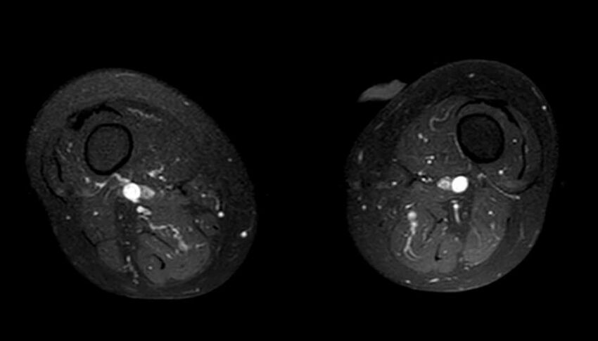Atypical lipomatous tumor - thigh (Radiopaedia 68975-78734 Axial T1 C+ fat sat 31).jpg