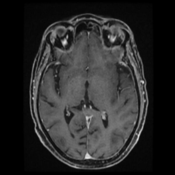 File:Atypical meningioma (Radiopaedia 45535-49629 Axial T1 C+ 37).jpg