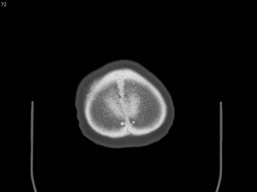 Atypical meningioma - intraosseous (Radiopaedia 64915-73867 Axial C+ bone window 72).jpg